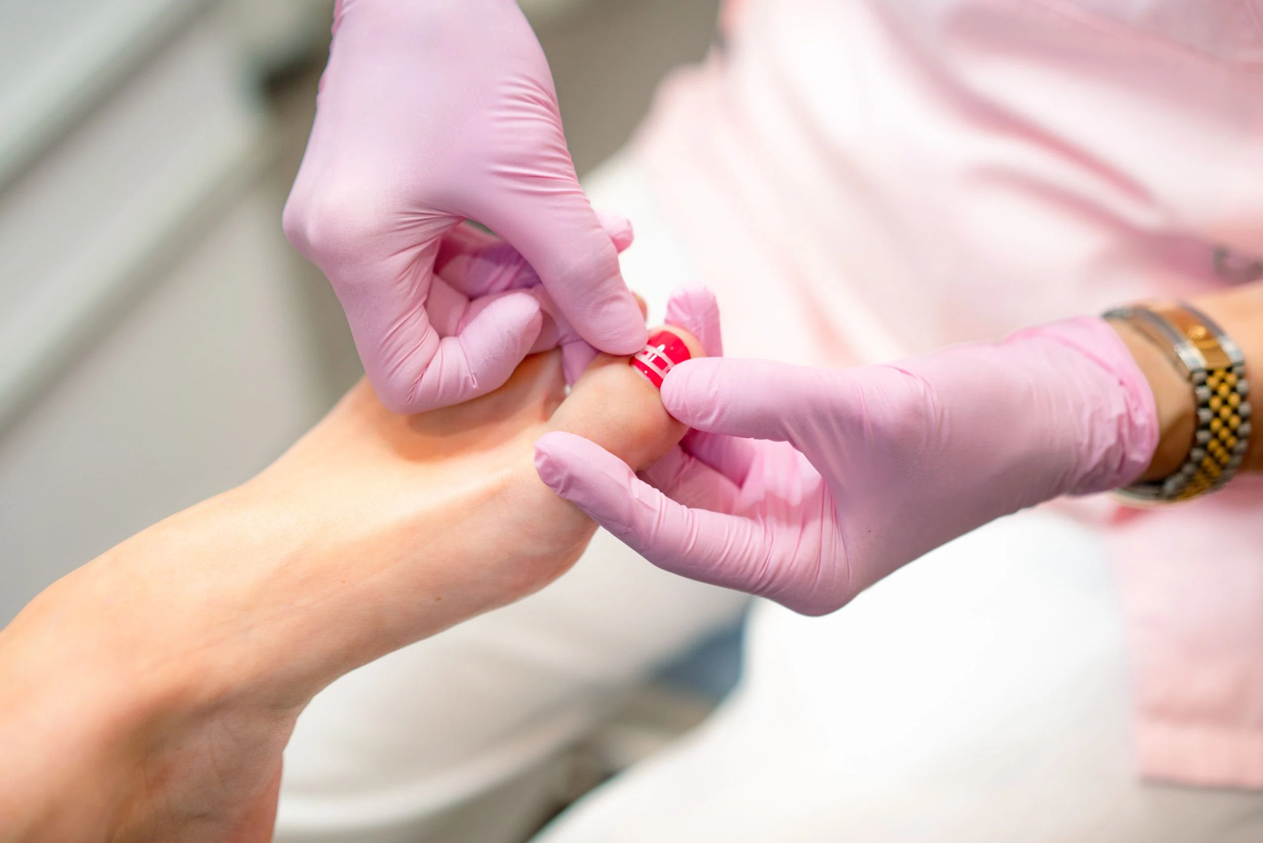 Nagelspangen&shy;behandlung