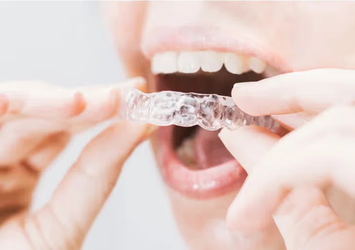 Invisalign
